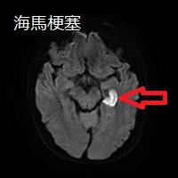 海馬梗塞 MRI画像