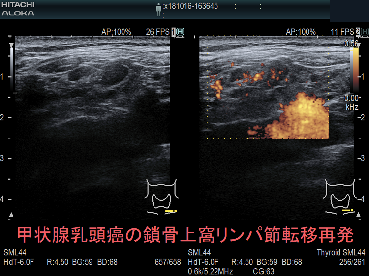 甲状腺乳頭癌の鎖骨上窩リンパ節転移再発 超音波(エコー)画像