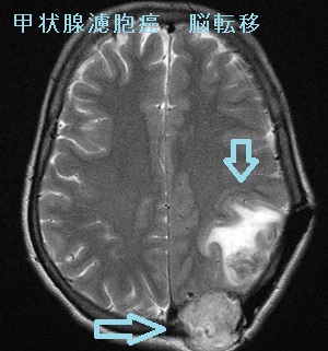 甲状腺濾胞癌 脳転移 MRI画像