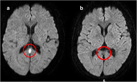 可逆性の脳梁膨大部病変を伴う軽症脳炎脳症 （MERS）