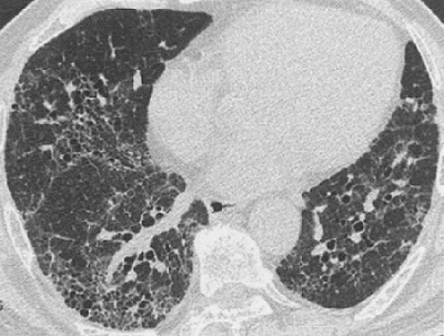特発性肺線維症 胸部CT