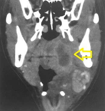 扁桃周囲膿瘍 造影CT