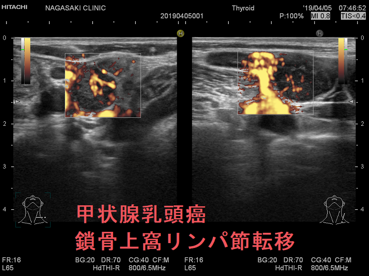 甲状腺乳頭癌 鎖骨上窩リンパ節転移 超音波(エコー)画像 ドプラーモード2
