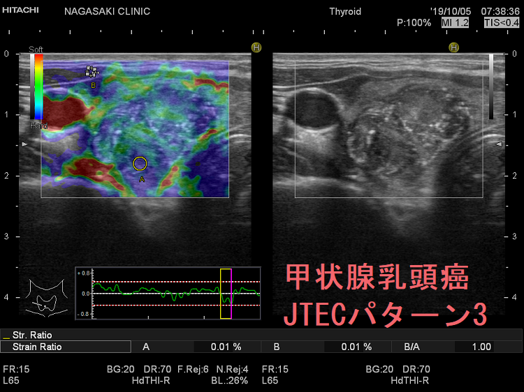 甲状腺乳頭癌 JTECパターン3