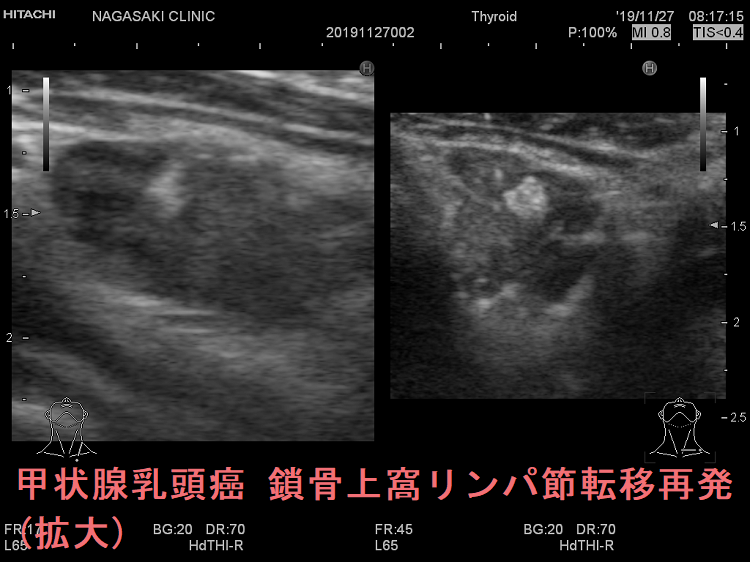 甲状腺乳頭癌 左鎖骨上窩リンパ節転移再発 超音波(エコー)画像(拡大)