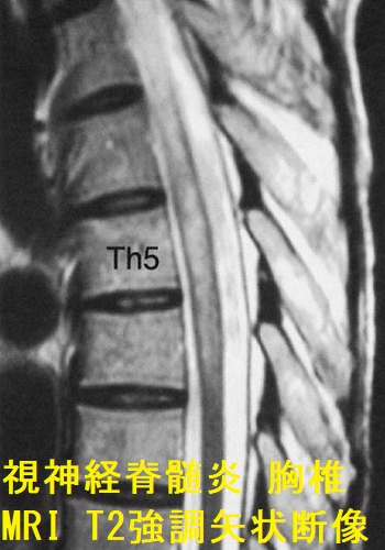 視神経脊髄炎 胸椎MRI T2 強調矢状断像