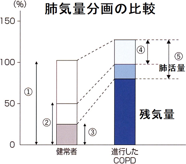 健常者と進行したCOPD 患者における肺気量分画の比較 健常者と進行したCOPD 患者における肺気量分画の比較