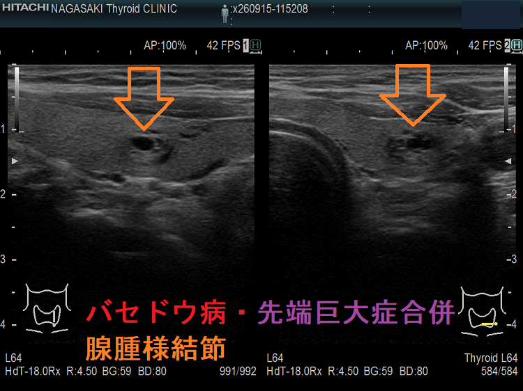 バセドウ病・先端巨大症合併 腺腫様結節 超音波(エコー)画像 バセドウ病・先端巨大症合併 腺腫様結節 超音波(エコー)画像