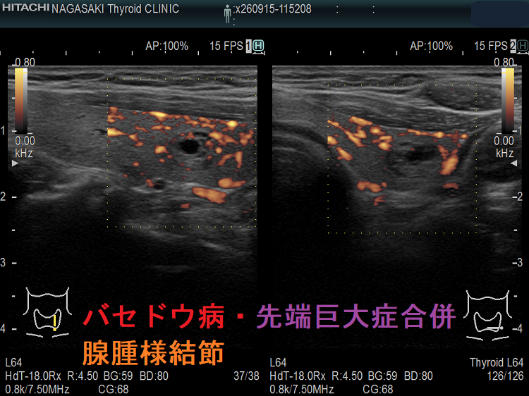 バセドウ病・先端巨大症合併 腺腫様結節 超音波(エコー)画像 ドプラーモード バセドウ病・先端巨大症合併 腺腫様結節 超音波(エコー)画像 ドプラーモード