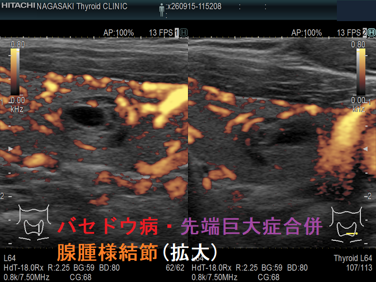バセドウ病・先端巨大症合併 腺腫様結節 超音波(エコー)画像 (拡大)ドプラーモード バセドウ病・先端巨大症合併 腺腫様結節 超音波(エコー)画像 (拡大)ドプラーモード