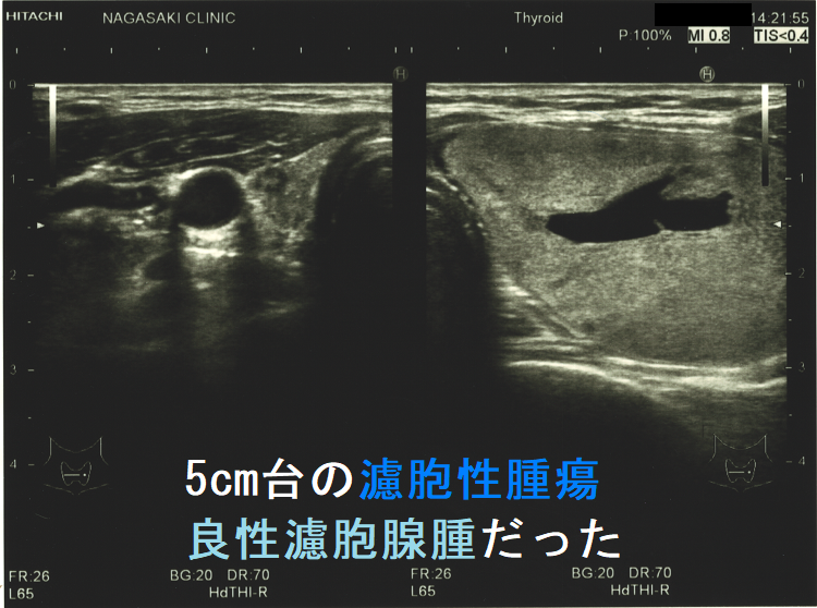 5cm台の濾胞性腫瘍 良性濾胞腺腫だった 全体像