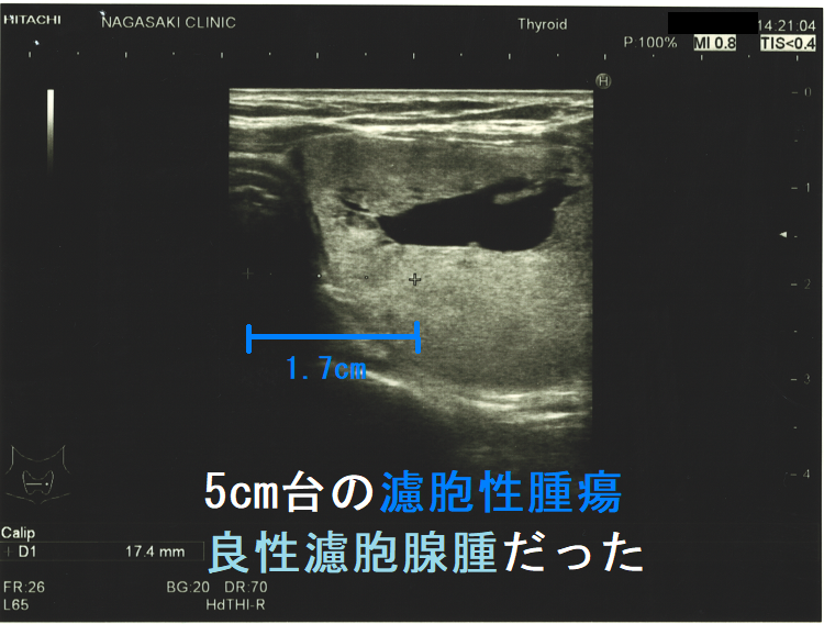 5cm台の濾胞性腫瘍 良性濾胞腺腫だった 気管偏位