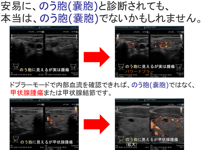 甲状腺のう胞(甲状腺嚢胞)と間違えられる甲状腺腫瘍・甲状腺結節